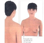 Tự kiểm tra ngực để phát hiện các dấu hiệu ung thư vú