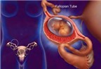 Làm sao có thai an toàn sau mổ thai ngoài tử cung, cắt vòi trứng?