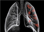 Mắc ung thư phổi, nhiều người bệnh chỉ sống được vài tháng