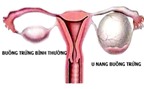 Bệnh u nang buồng trứng: Nguyên nhân, triệu chứng