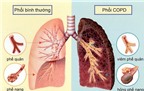 Làm sao để bệnh phổi tắc nghẽn mạn tính không trở nặng?