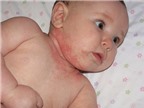 Chàm thể tạng - bệnh viêm da gây khó chịu cho trẻ nhỏ