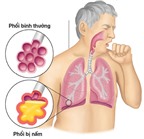 Bệnh u nấm phổi