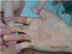 Phòng tránh di chứng bỏng gây sẹo co rút bàn tay ở trẻ em