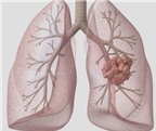 Đột biến gen ALK gây ung thư phổi
