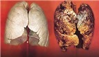 Điều trị ung thư biểu mô tuyến phổi