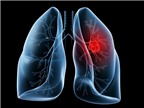 Ung thư biểu mô tuyến phổi
