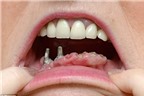 Mất nguyên hàm dưới do ghép răng sai cách