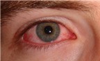 Một số triệu chứng của bệnh đau mắt đỏ