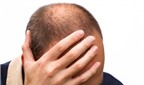 Đàn ông hói đầu có nguy cơ ung thư tuyến tiền liệt?