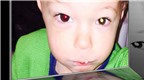 Chụp ảnh bật flash có thể giúp phát hiện ung thư mắt ở trẻ nhỏ