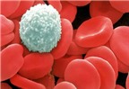 Dấu hiệu bệnh ung thư máu và cách điều trị