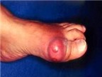 Khớp ngón chân cái sưng đỏ, đề phòng bệnh gút