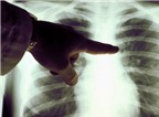 Ung thư phổi khó phát hiện kể cả giai đoạn sớm