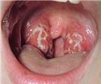Ung thư vòm họng giai đoạn đầu có biểu hiện gì?