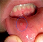 Cách phân biệt ung thư lưỡi và nhiệt miệng