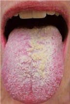 Nhìn màu sắc của lưỡi biết ngay mắc bệnh gì