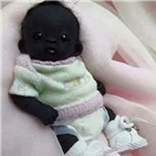 Giật mình với hình ảnh em bé có làn da đen nhất thế giới