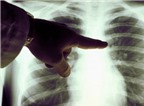 Ung thư phổi: Những triệu chứng không thể bỏ qua