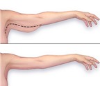Cách giảm béo cho cánh tay hiệu quả
