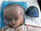 Em bé mắc bệnh đầu to được tái tạo bằng sọ 3D