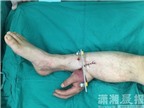 Người đàn ông được cứu bàn tay bằng cách ghép vào bụng chân