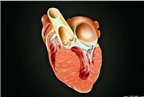 Khó khăn trong chữa bệnh cơ tim hạn chế
