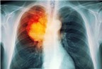 Nhiều nguyên nhân gây ung thư phổi