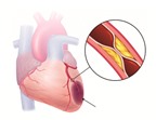 Cách phòng 2 bệnh tim thường gặp
