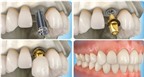 Trồng răng giả bằng phương pháp cấy ghép Implant