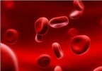 Thiếu máu: Nguyên nhân và cách điều trị