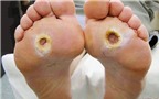 Nấm chân – Căn bệnh dễ gặp nhất khi thường xuyên đi mưa