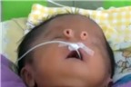Chuyện lạ có thật: Em bé sinh ra có hai ‘mũi’