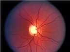 Glaucoma - căn bệnh giấu mặt