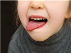 Lưỡi có màu bất thường, bệnh gì?