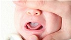 Nguyên nhân và cách điều trị bệnh tưa lưỡi ở trẻ sơ sinh
