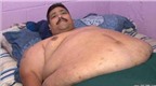 Người béo nhất thế giới cắt dạ dày để giảm cân