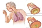 Các triệu chứng điển hình của lao phổi?