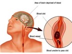 Tai biến mạch máu não – Phòng ngừa và chữa trị